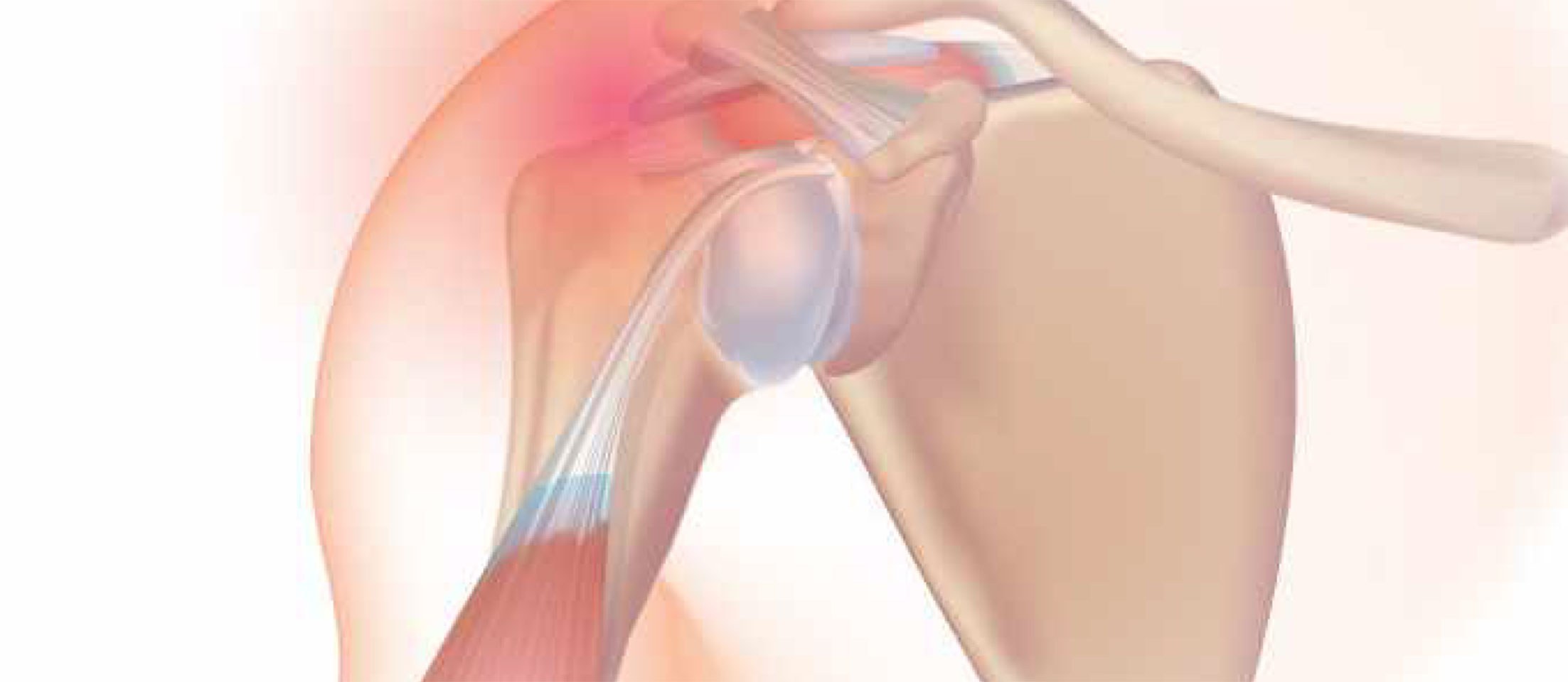 Inflammation